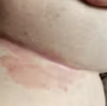 Before – red, irritated skin